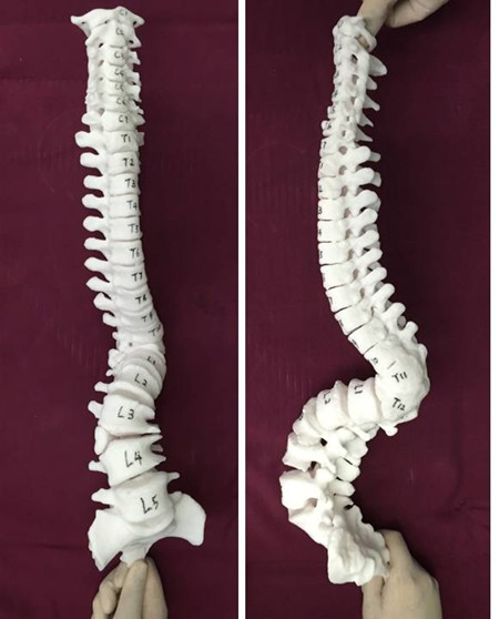 图3  应用3D打印脊柱模型辅助手术_副本.jpg